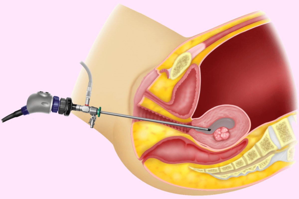 Diagnostic and Operative Hysteroscopy