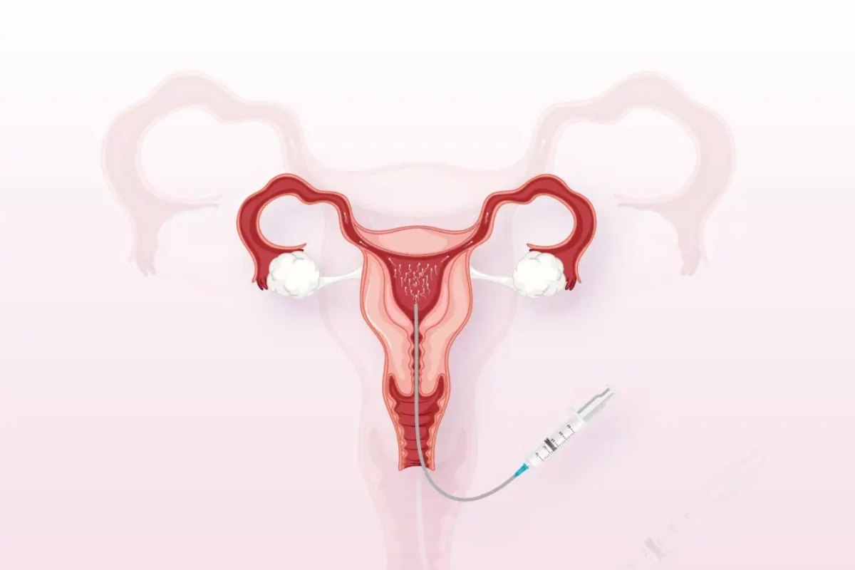 IUI Treatment